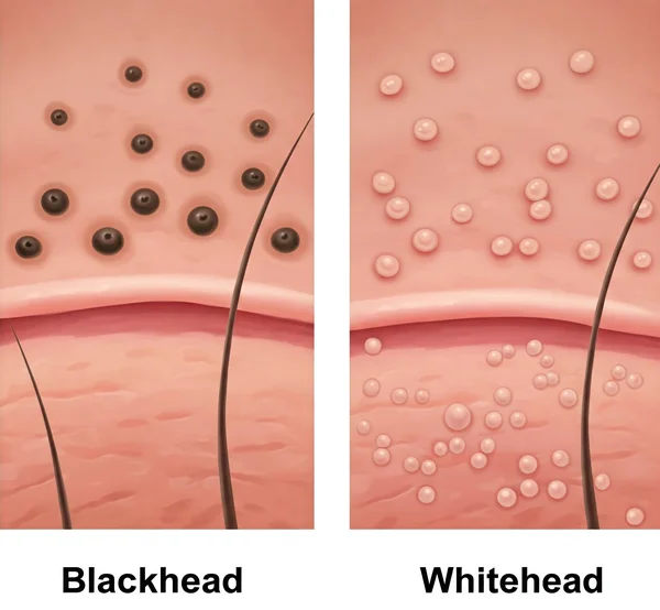 Illustration of blackheads and whiteheads (comedones).