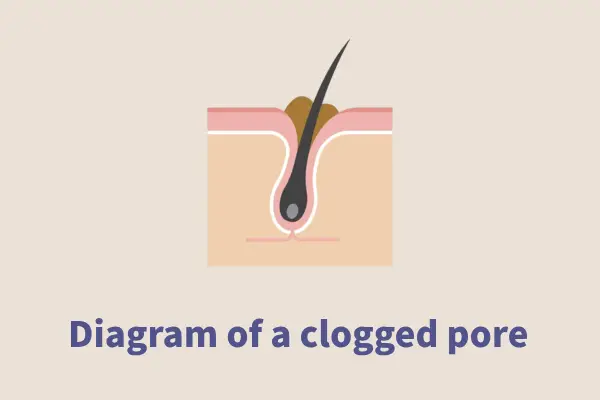 Rajah pori tersumbat