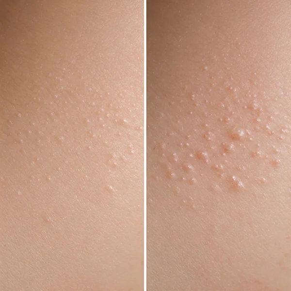 Comparison of smooth vs. bumpy skin texture (clogged pores).