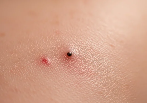 Magnified view of skin with clogged pores and acne