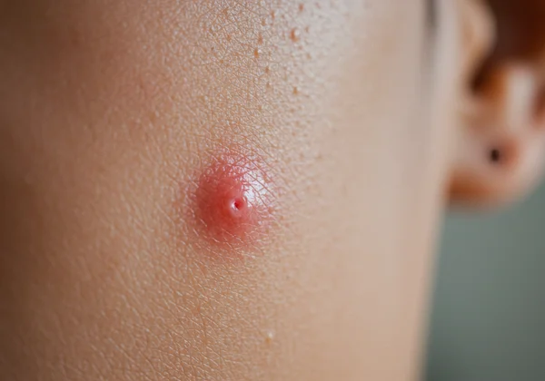 Close-up of a clogged pore on frustrated skin.