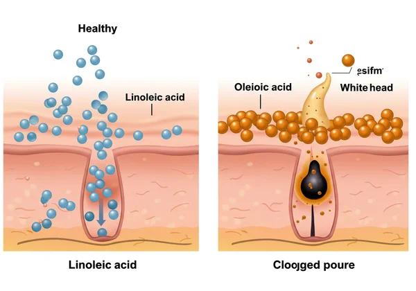 Illustration of clogged and clear pores with oil molecules