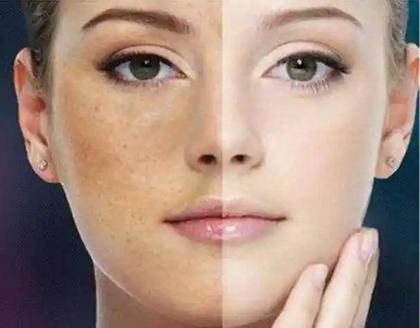 Comparison of healthy skin and skin affected by clogged pores and acne.